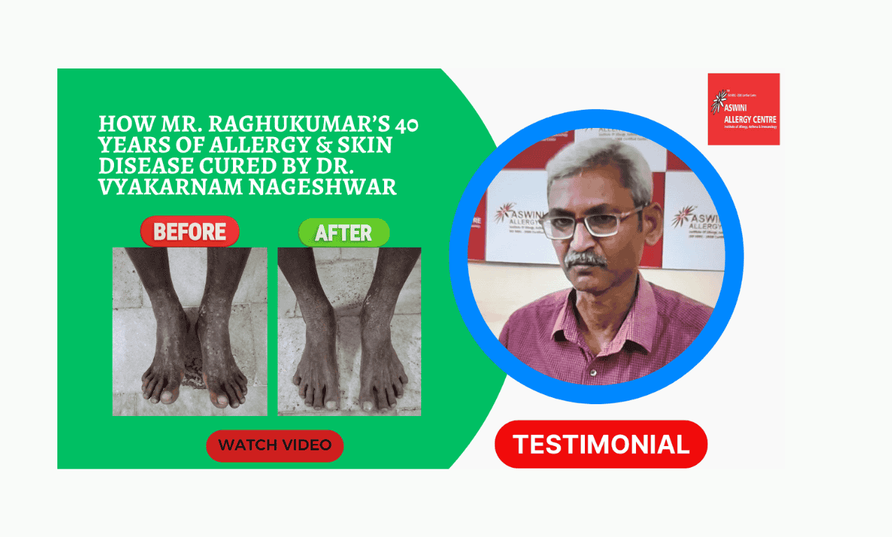 Looking for long-term allergy treatment in Hyderabad? Discover how a 57-year-old patient overcame 40 years of chronic skin rashes and breathing issues with advanced immunotherapy at Aswini Allergy Centre.