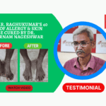 Looking for long-term allergy treatment in Hyderabad? Discover how a 57-year-old patient overcame 40 years of chronic skin rashes and breathing issues with advanced immunotherapy at Aswini Allergy Centre.