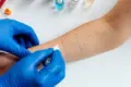 Allergy Testing