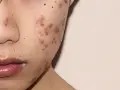 Skin Allergy