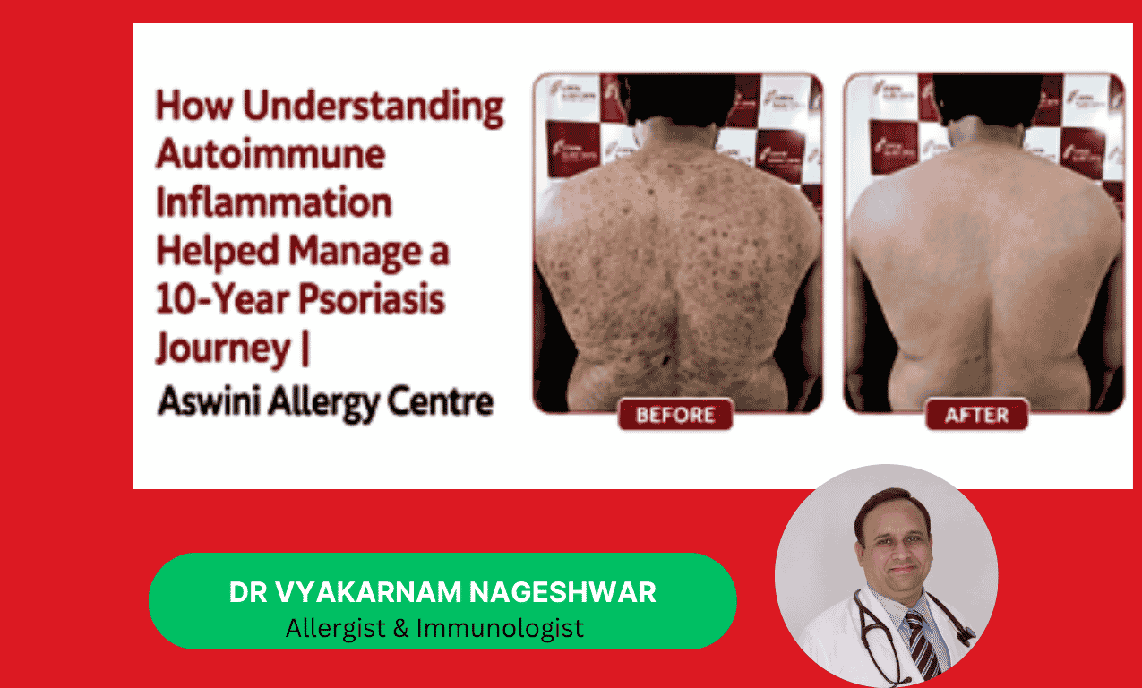 Learn how autoimmune inflammation may contribute to psoriasis and read a real patient recovery journey after 10 years of psoriasis at Aswini Allergy Centre.